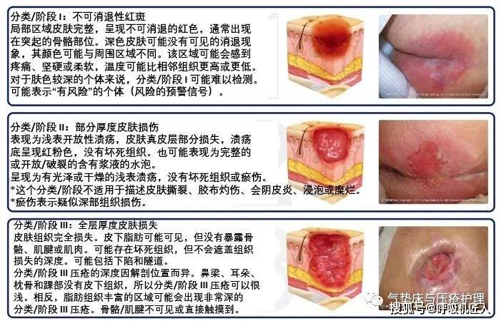 压疮的分期及临床表现最新版